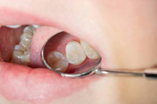 caries spoiled tooth close-up photographed through dental mirror