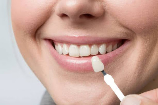 Close Up of using shade guide at woman's mouth to check veneer of tooth crown