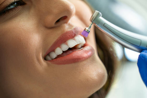 Closeup shot of teeth whitening procedure , young woman patient